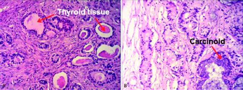 Histologic Examination Hematoxylin And Eosin Staining Of The Strumal