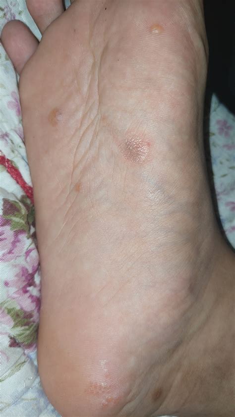 These Bumps Keeps On Appearing At The Bottom Of My Foot It Itches What