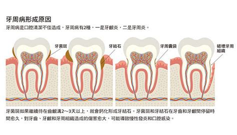 牙周病症狀指南│聰明看牙醫。培養咀嚼力│康健雜誌