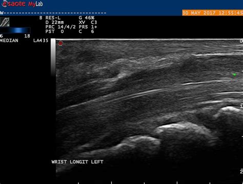 Ultrasound imaging after surgery | Carpal-Tunnel.net