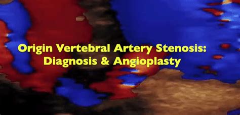 Origin Vertebral Artery Stenosis: Diagnosis & Angioplasty - Echovision