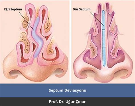 Septum deviasyonu nasıl tedavi edilir Prof Dr Uğur Çınar