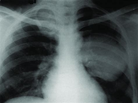 Chest Radiograph Postero Anterior View Showing Two Homogeneous