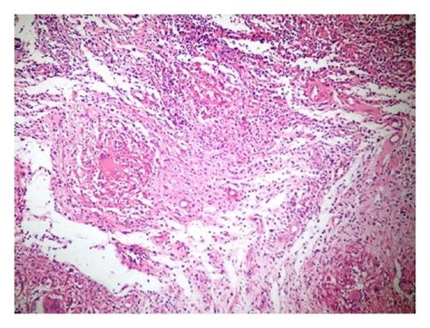 Hematoxylin And Eosin Stained Biopsy Specimen Showing Typical Areas Of