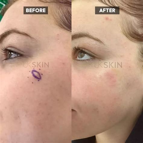 Expert Cyst Removal From £345 Ukskin