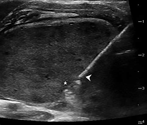 Radiofrequency Ablation Of Solid Benign Thyroid Nodules Techniques In Vascular