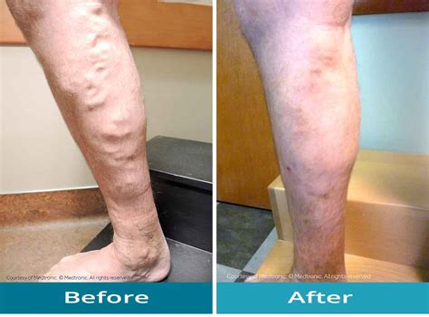 Case Mild Varicose Veins Comprehensive Vein Care