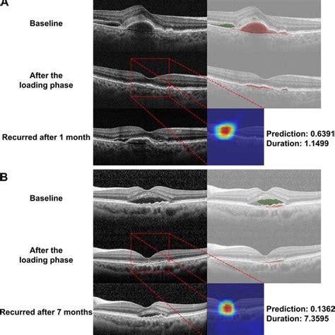 Representative cases of neovascular age-related macular degeneration.... | Download Scientific ...