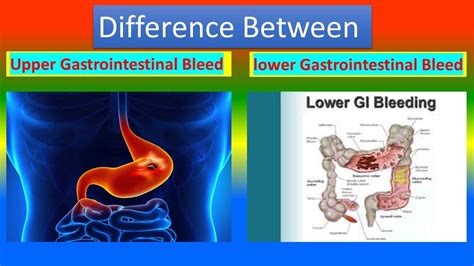 Difference Between Upper Gastrointestinal Bleed And Lower