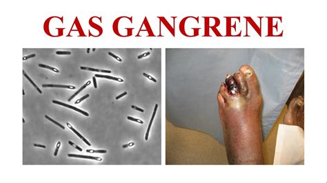 Gas Gangrene Youtube