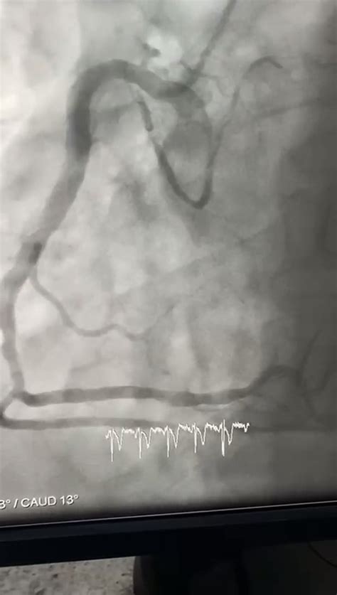 Caso Cl Nico Infarto Agudo Del Miocardio Avance Cardiol Gico