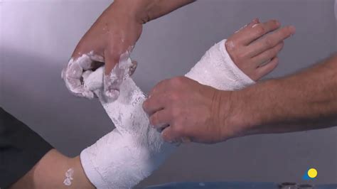 Short Arm Cast Below Elbow Using Plaster Of Paris Youtube