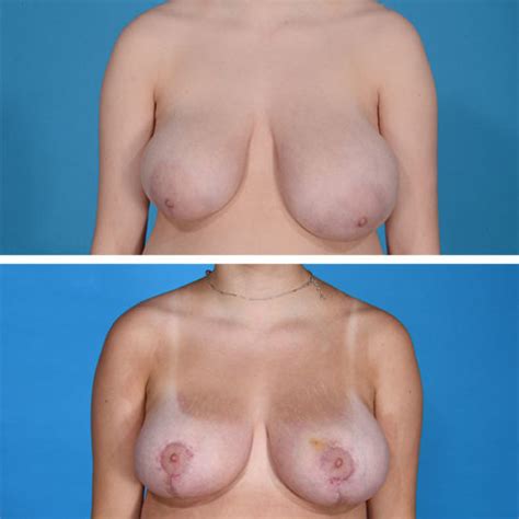 Breast Reduction Dr Jeffrey Lisiecki