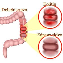 Ulcerozni Kolitis I Stres