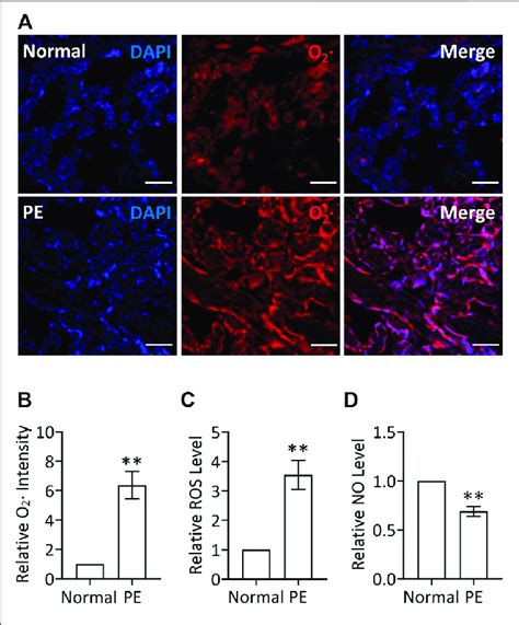 Increased ROS Levels And Decreased NO Levels In PE Placenta A DHE