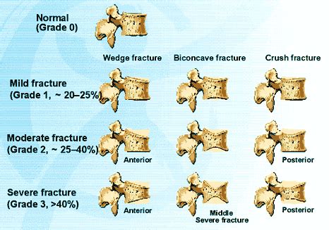 Vertebral fractures | International Osteoporosis Foundation