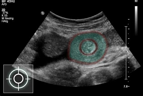 Target Sign Intussusception Ultrasound