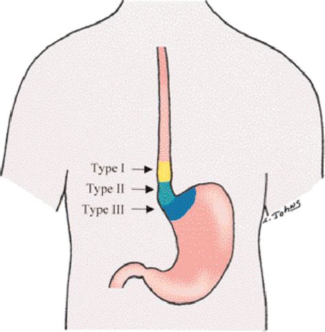 Figure 511 From Adenocarcinoma Of The Esophagus And Gastroesophageal