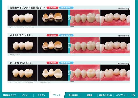 補綴物｜ブリッジ│藤原歯科医院