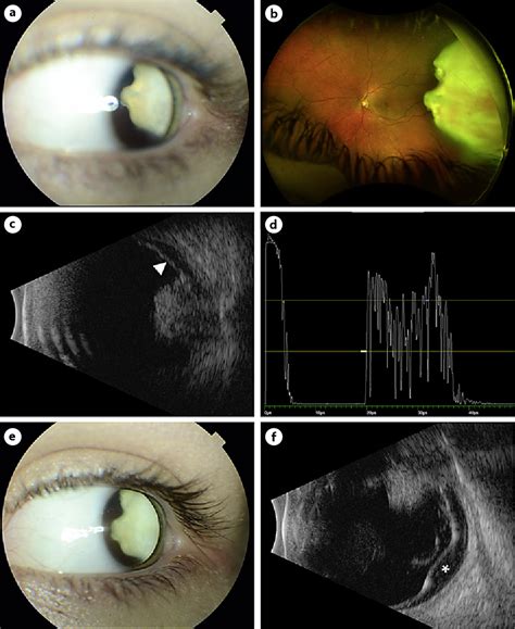 Figure From Histopathology Of Intraocular Medulloepithelioma