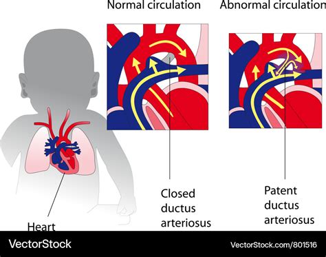 Patent Ductus Arteriosus Medicine Poster Vector Image