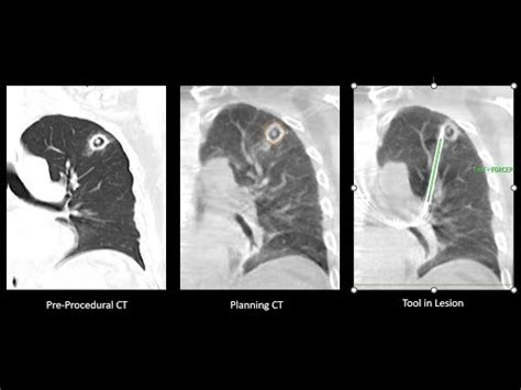 CONE BEAM CT GUIDED LUNG BIOPSY LEFT UPPER LOBE CAVITY YouTube