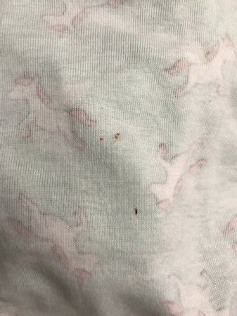 Baby umbilical cord fell off prematurely!!! What do i do? | BabyCenter