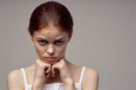 Woman With Pimple On Her Face Touching Face With Hands Health Problems