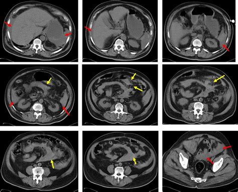 Blunt Abdominal Trauma Mesenteric Injury Radiology Cases