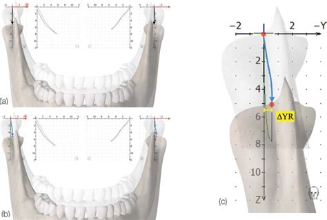 Protrusion/retrusion movement showing ( ) normal movement and ...