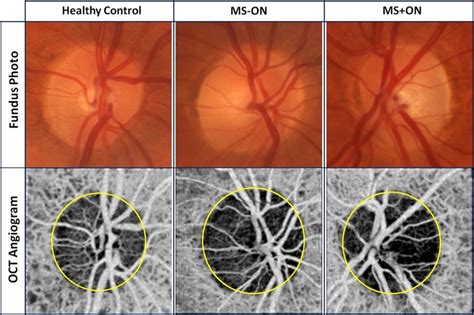 Optic Neuritis Multiple Sclerosis