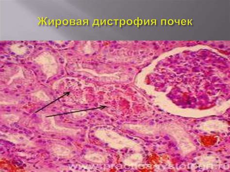Дистрофии - презентация онлайн