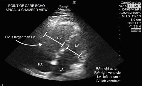 Half Dose Alteplase For Sub Massive Pulmonary Embolism Directed By