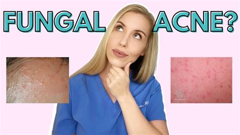 Do You Have Fungal Acne Dermatologist Talks Symptoms And Treatments Youtube