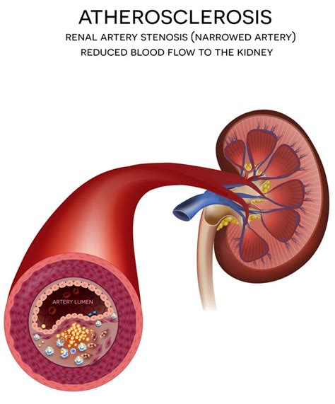 Renal Artery Stenosis Miva Medical