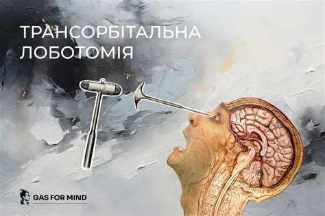 Лоботомія: історія найбільш суперечливої операції