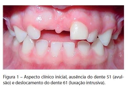 Utilização de prótese parcial fixa modificada na primeira infância