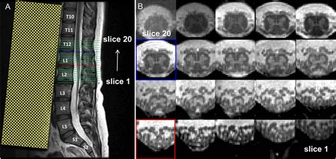 A Sagittal T2 Weighted Turbo Spin Echo Acquisition In The Lower Spine