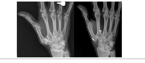 Figure 1 from Thumb-Basal Joint Arthroplasty Outcomes and Metacarpal ...