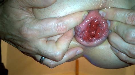 My Wide Open Asshole Prolapse And Rosebutt Gay Porn XHamster