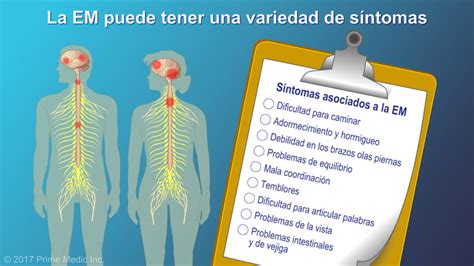 Explicación De La Esclerosis Múltiple