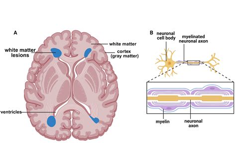 What Is The Link Between White Matter Lesions And Neurodegeneration