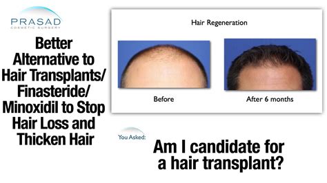 Better Alternative To Hair Transplant Finasteride Minoxidil To Thicken Hair And Stop Hair Loss