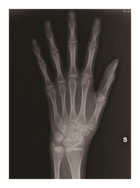 Left Hand And Wrist X Ray The Ossification Of The Epiphysial Cartilage Download Scientific