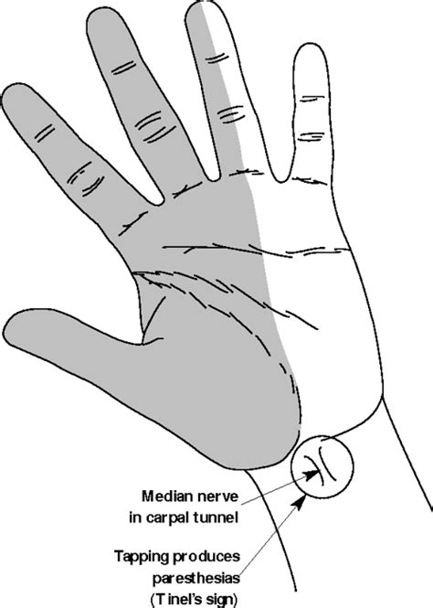 Figure 2 From Tinels Sign And Phalens Maneuver Physical Signs Of