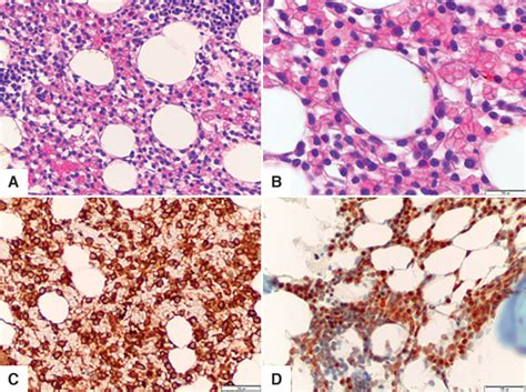 Figure 3 The Histology Of Bone Marrow Involved By Hairy Cell Leukemia