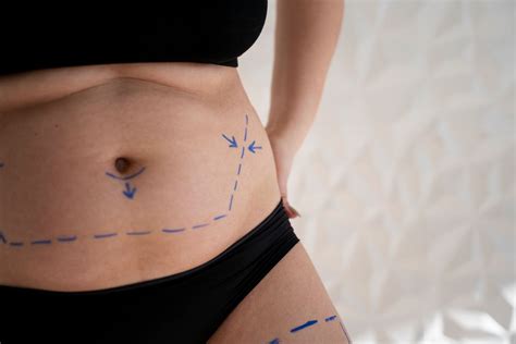 Qual O Tempo De Recupera O Para A Lipoabdominoplastia Mila