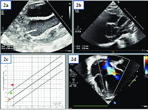 2d Echocardiography Findings 2a Transthoracic Echocardiography Tte