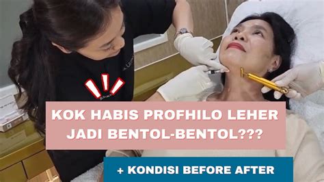 Skin Booster Profhilo Leher Before After Nyata Bentolnya Ovela