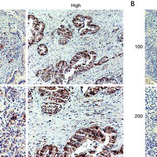 Kif Mrna Expression In Pancreatic Tumor Tissue And Normal Pancreatic